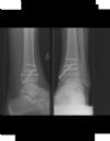 Pilon fracture.Post ORIF radiographs. Courtesy of Dushan Atkinson