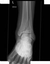 Pilon fracture. AP radiograph. Courtesy of Dushan Atkinson