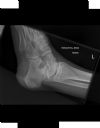 Pilon fracture. Lateral radiograph. Courtesy of Dushan Atkinson