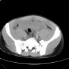 Lateral compression pelvic fracture. CT. Courtesy of Dushan Atkinson
