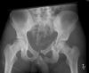 Lateral compression pelvic fracture. Radiograph. Courtesy of Dushan Atkinson