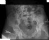Comminuted pelvic fracture. Radiograph. Courtesy of Dushan Atkinson