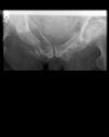 Pelvic fracture. Radiograph. Courtesy of www.healthengine.com.au