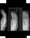 4th and 5th metacarpal fractures. Radiograph. Courtesy of www.healthengine.com.au