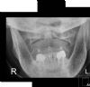 Fracture through the left anterior and posterior arches of the atlas with some lateral displacement of the left lateral mass. AP Radiograph.
