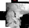 Fracture through the left anterior and posterior arches of the atlas with some lateral displacement of the left lateral mass. CT 3D reconstruction 2.